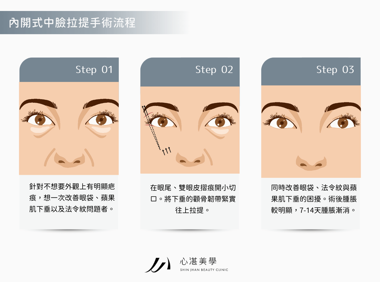 內開式中臉拉提手術_眼袋手術_蘋果肌拉提_淡化法令紋_小臉拉提示意圖