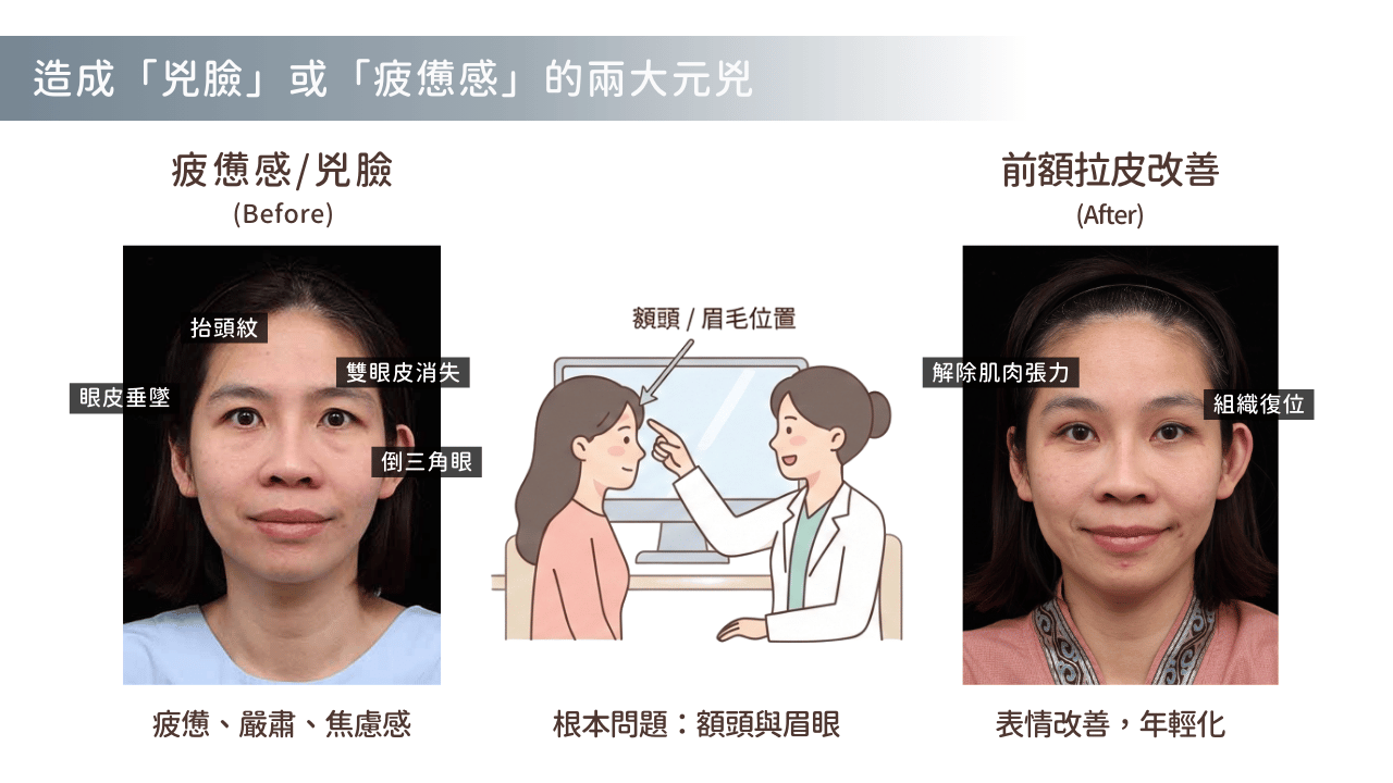 前額拉皮術前術後對比，改善眉下垂與額頭皺紋的效果