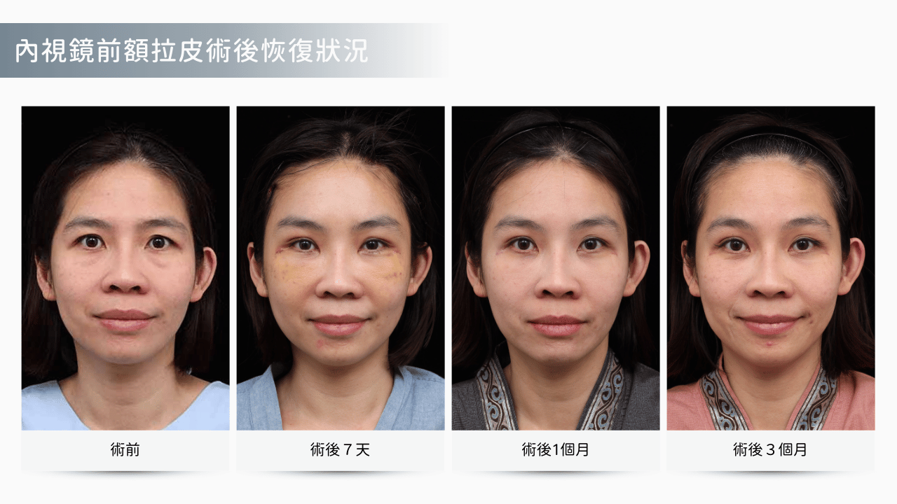前額拉皮術後恢復時間軸圖表，顯示第1天到第90天的消腫變化