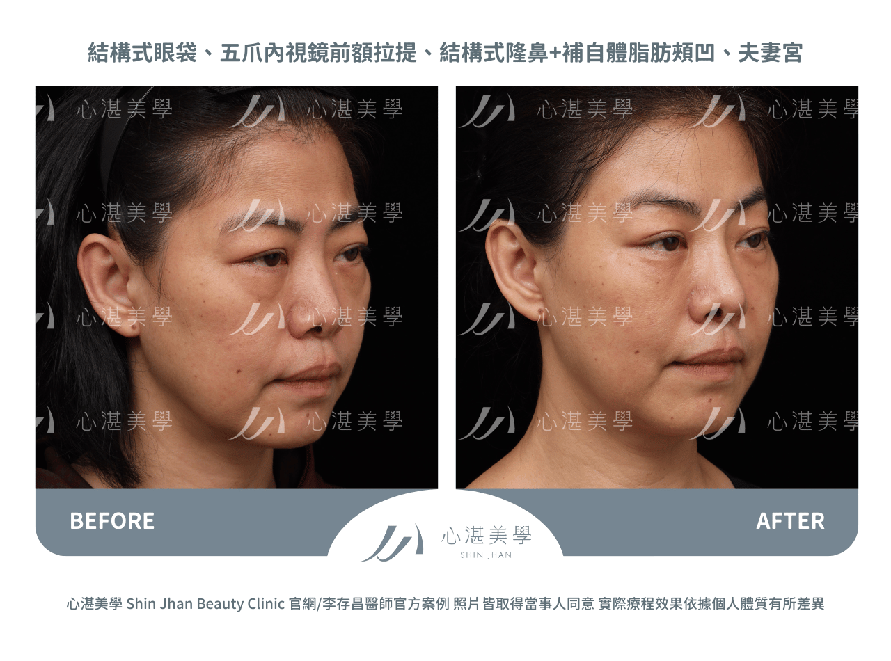 前額拉皮術前術後對比實際案例