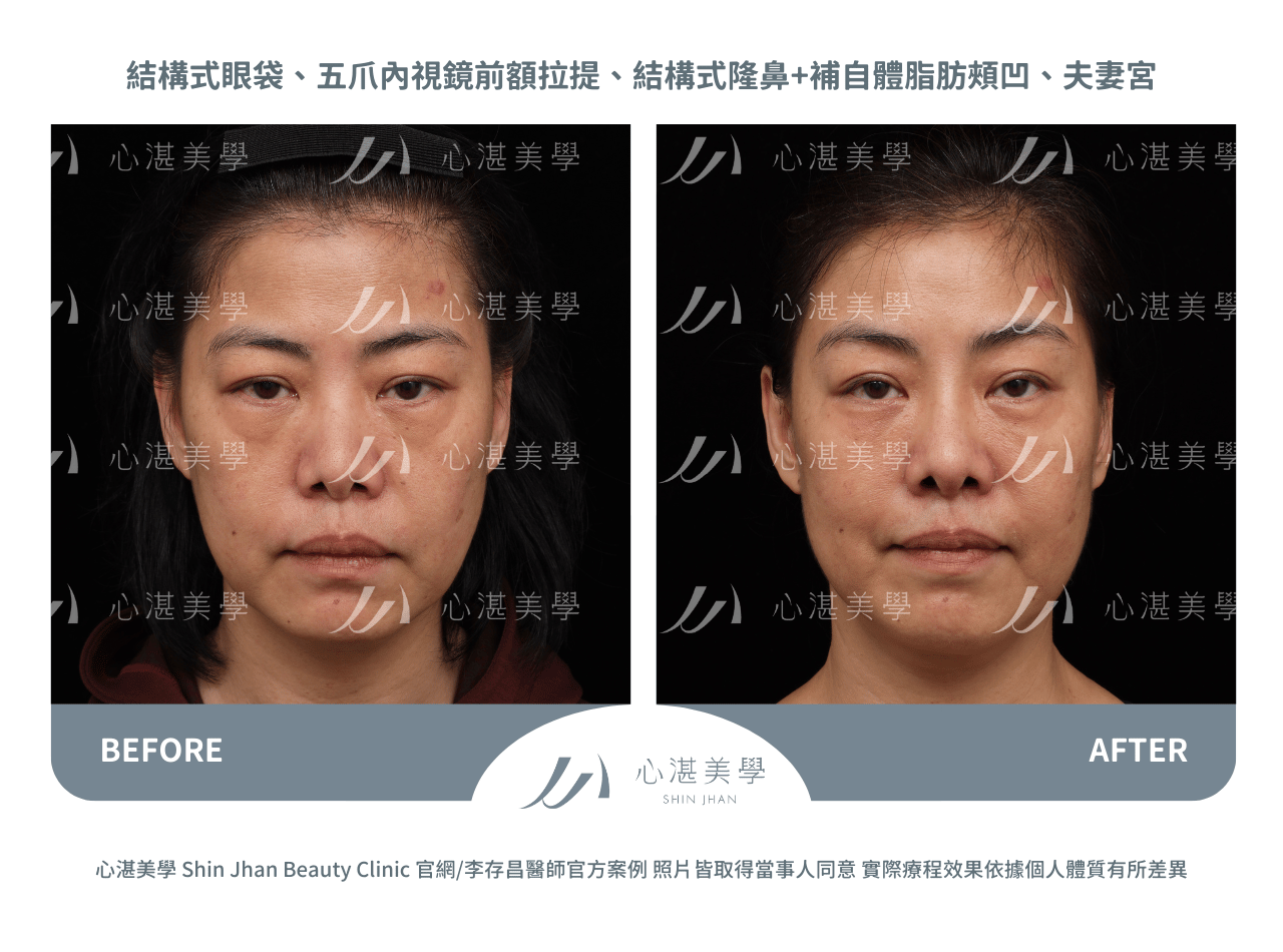 前額拉皮術前術後對比實際案例
