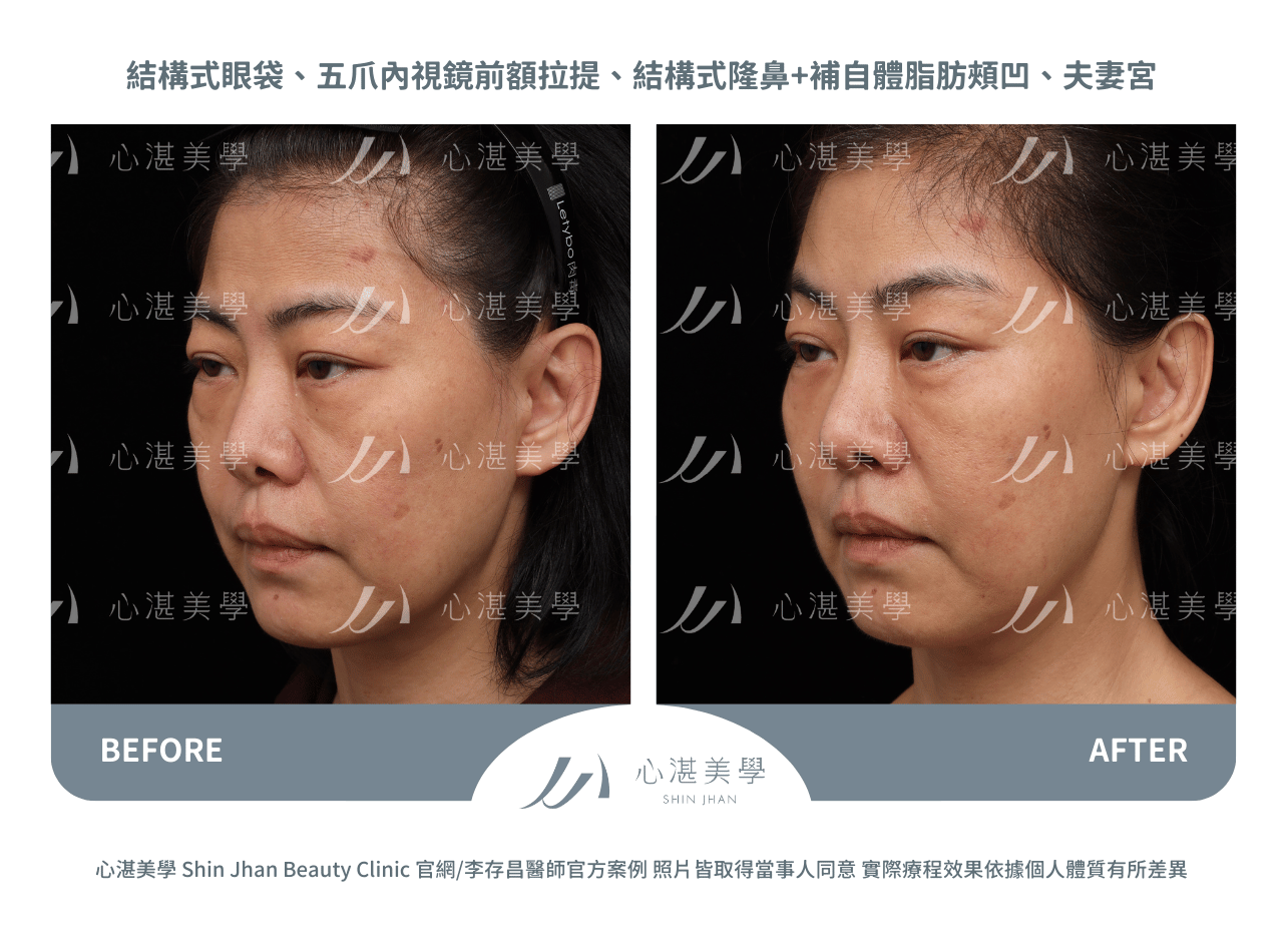 前額拉皮術前術後對比實際案例
