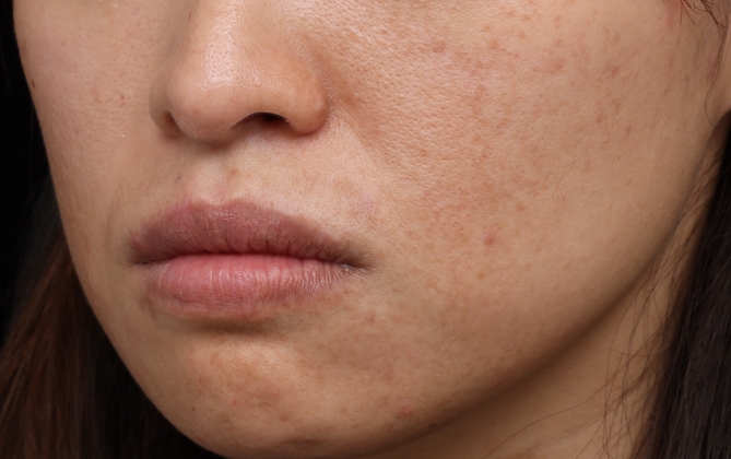 結構型（天生型）法令紋特徵