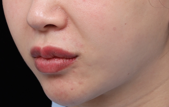 韌帶拉扯型（肌肉型）法令紋特徵