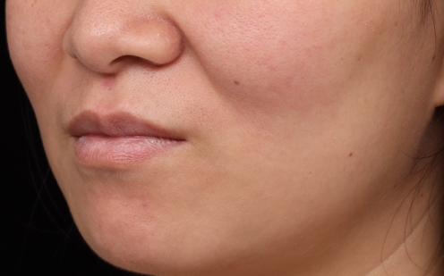 鬆弛老化型法令紋特徵