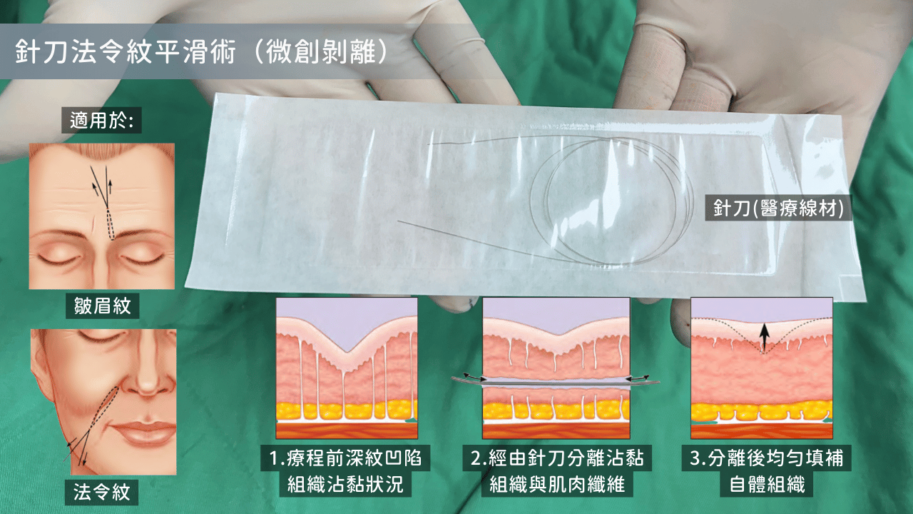 針刀圖示以及針刀無痕法令紋平滑術之原理與適用狀況。