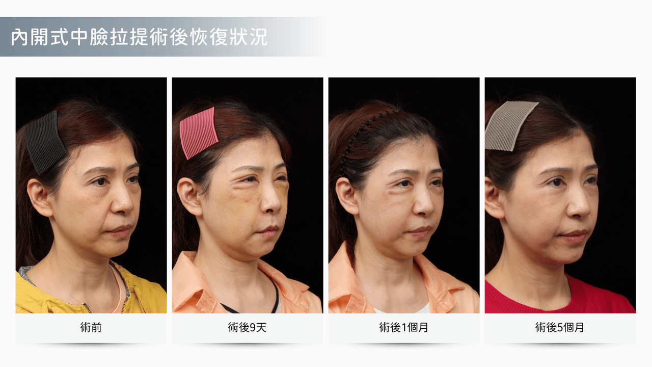 內開式經下眼瞼中臉拉提恢復時間軸圖表，顯示第1天到第150天的消腫變化。