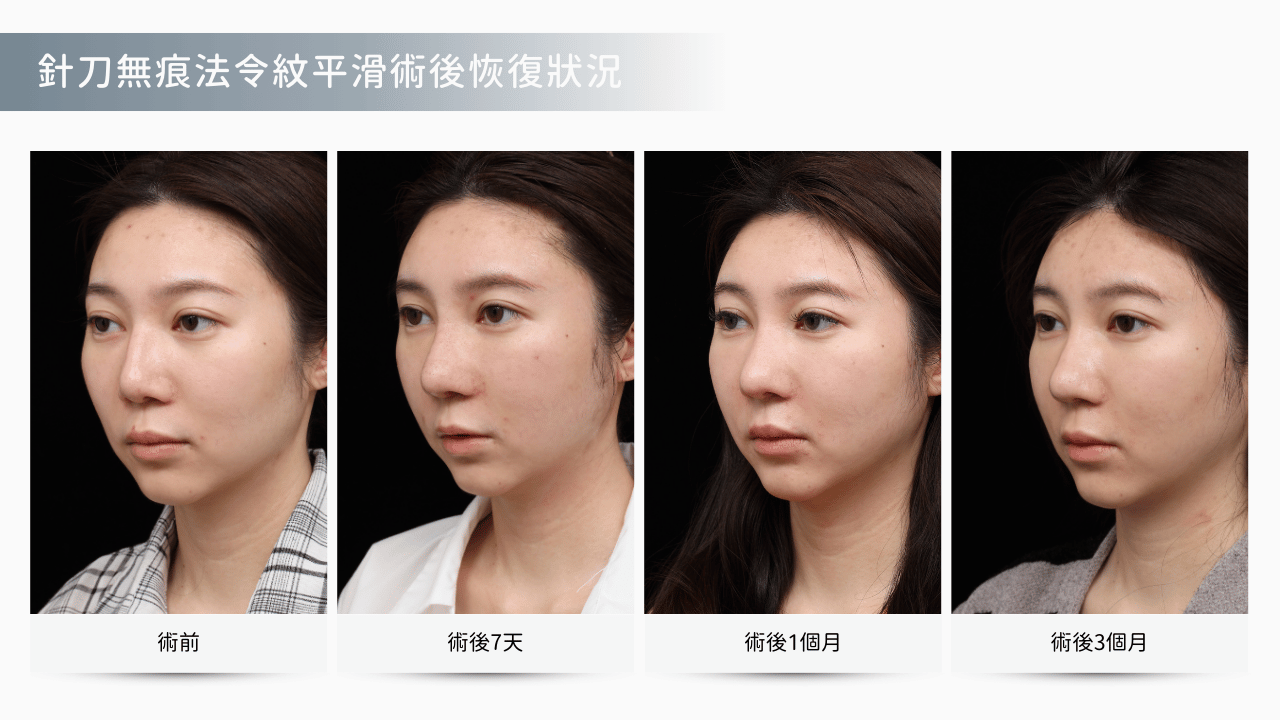 針刀無痕法令紋平滑術恢復時間軸圖表，顯示第1天到第90天的消腫變化。