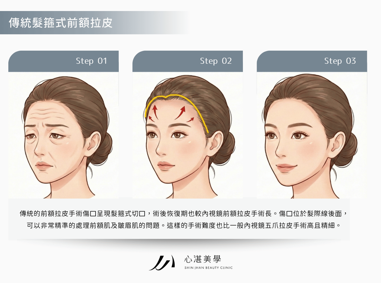 傳統前額拉皮手術方式，適合嚴重皮膚垂墜