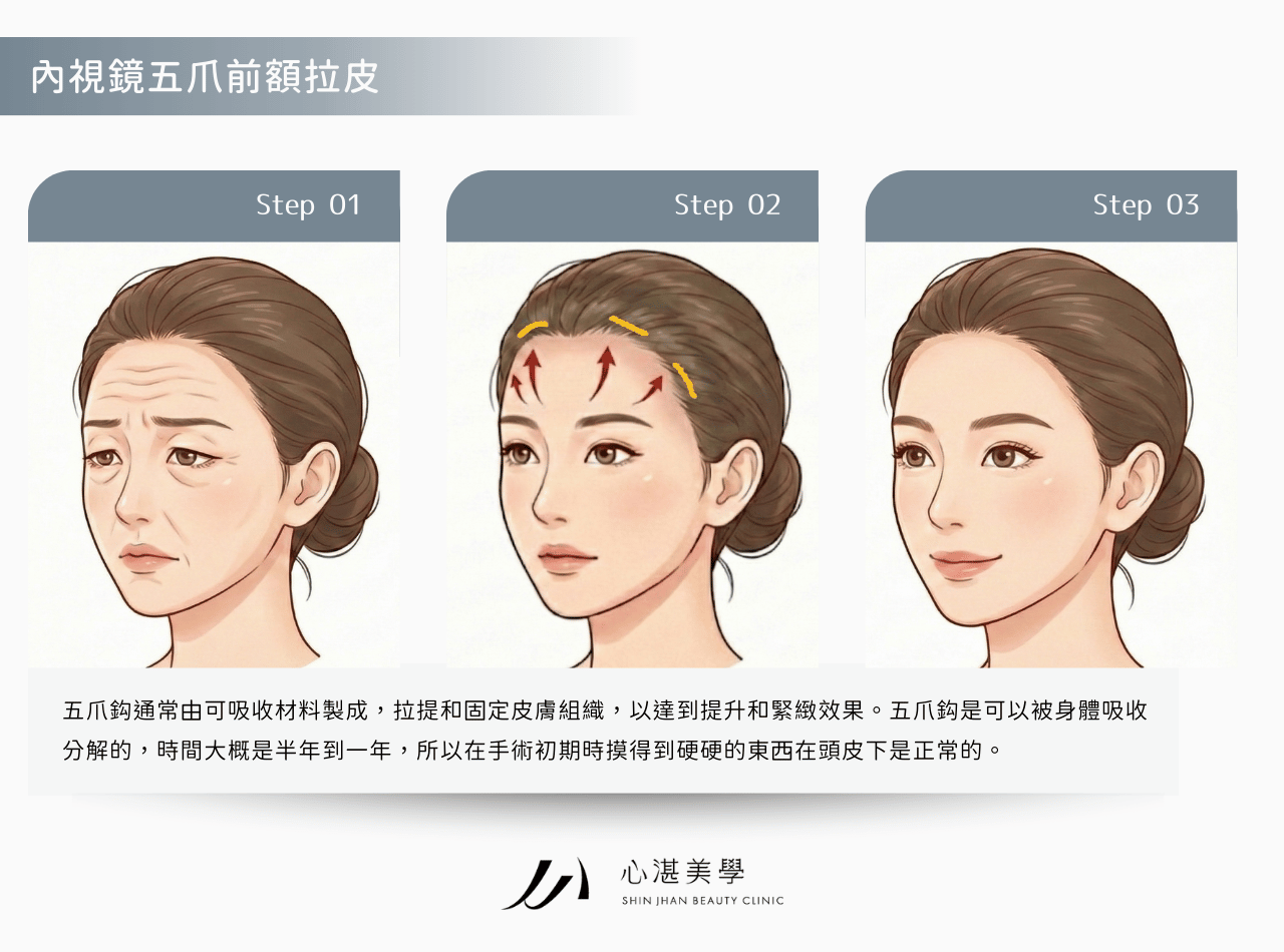 內視鏡隱痕五爪前額拉皮－適合輕度皮膚垂墜