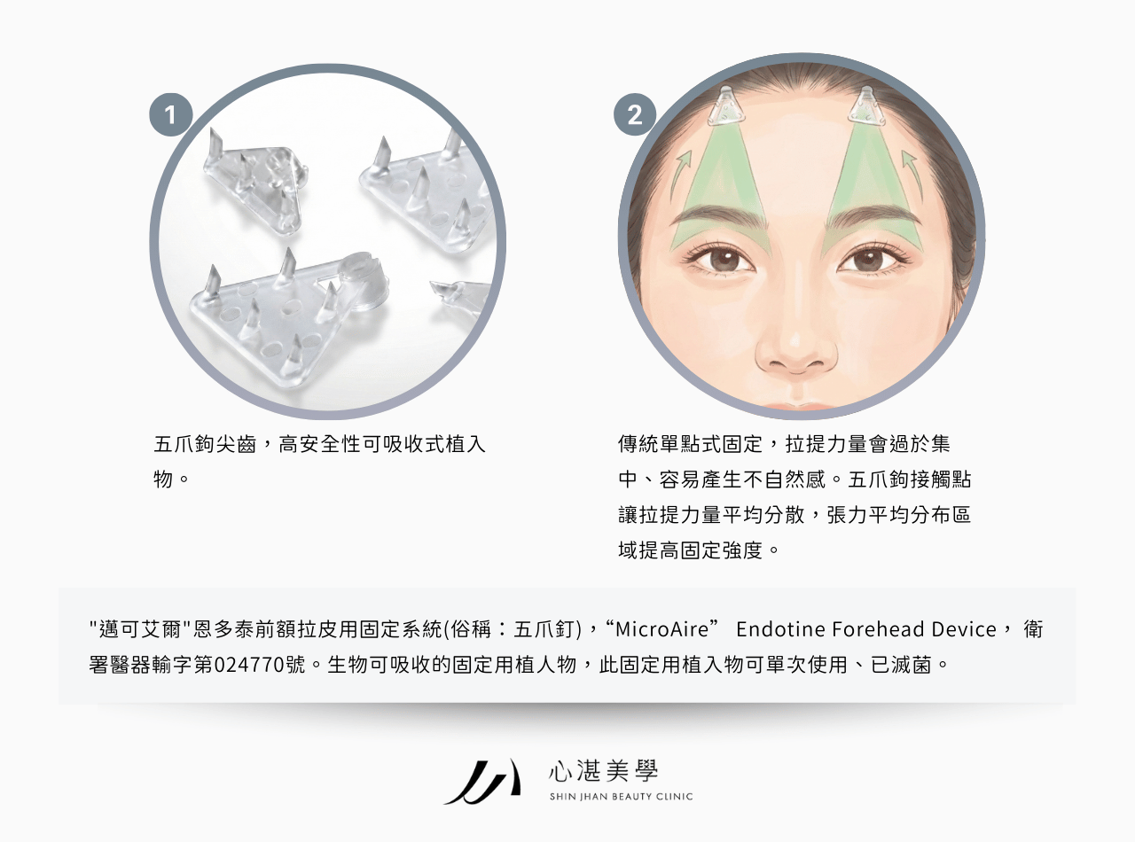 內視鏡隱痕五爪前額拉皮－適合輕度皮膚垂墜