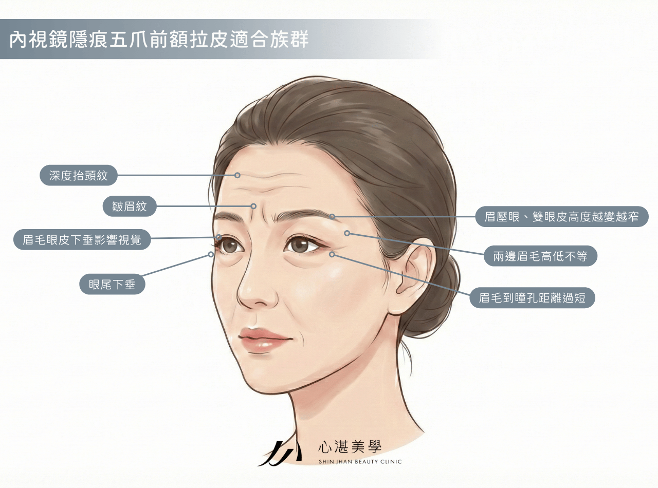 內視鏡隱痕五爪前額拉皮適合族群