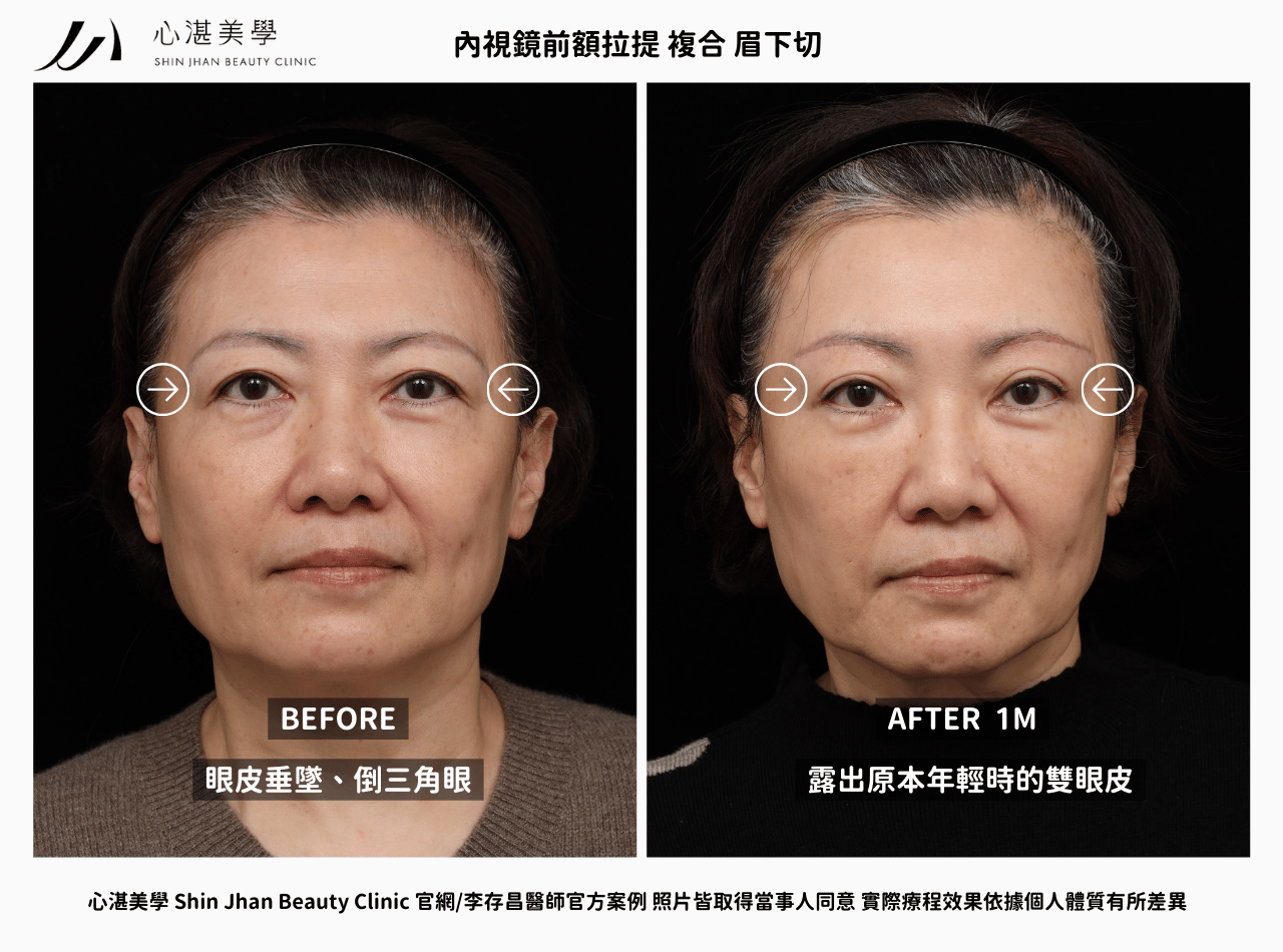 內視鏡前額拉提 複合 眉下切術前術後案例對比