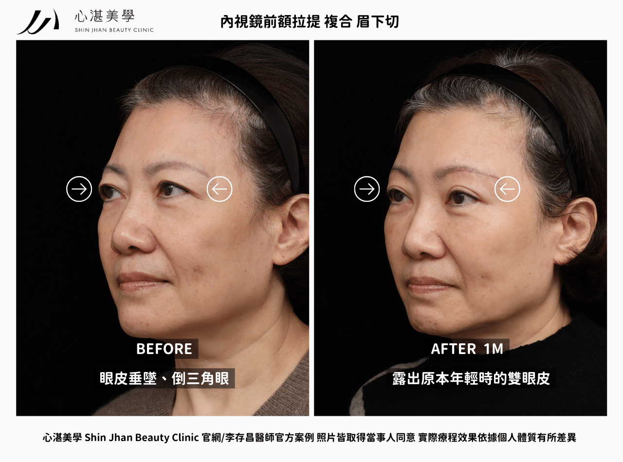 內視鏡前額拉提 複合 眉下切術前術後案例對比