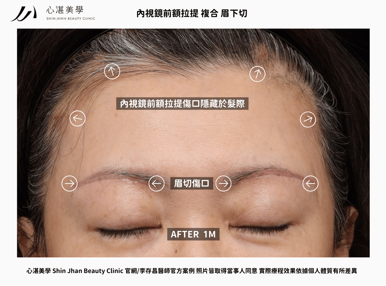 內視鏡前額拉提 複合 眉下切術前術後案例對比