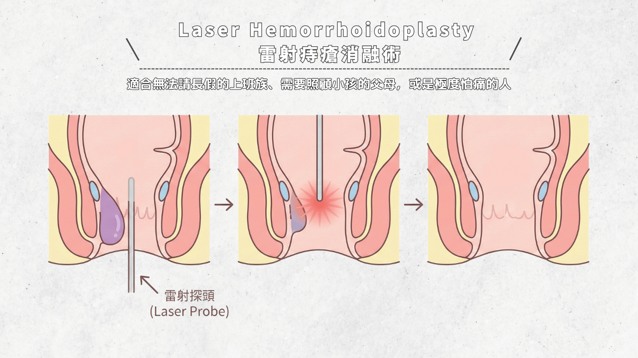 雷射痔瘡消融術