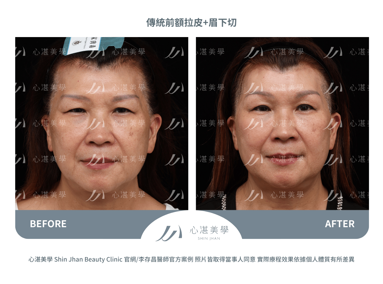傳統前額拉皮+眉下切術前術後案例分享