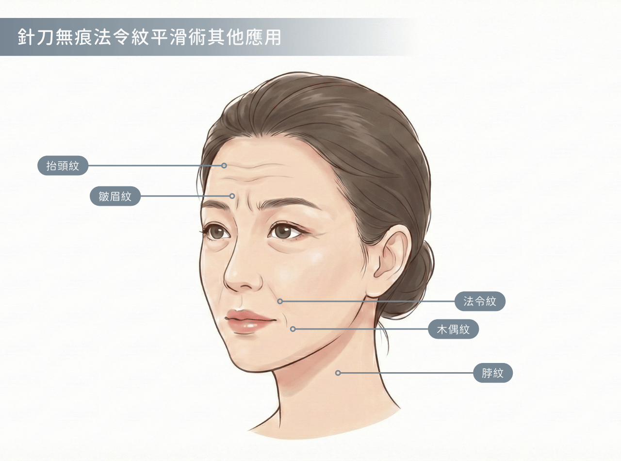 針刀手法可以運用在其他深紋、皺紋上嗎？