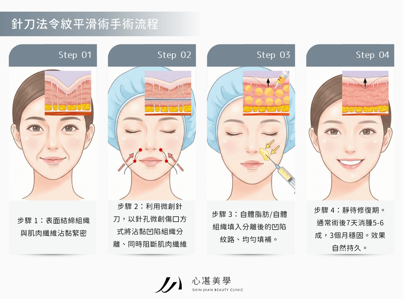 針刀無痕法令紋平滑術的手術原理與方式