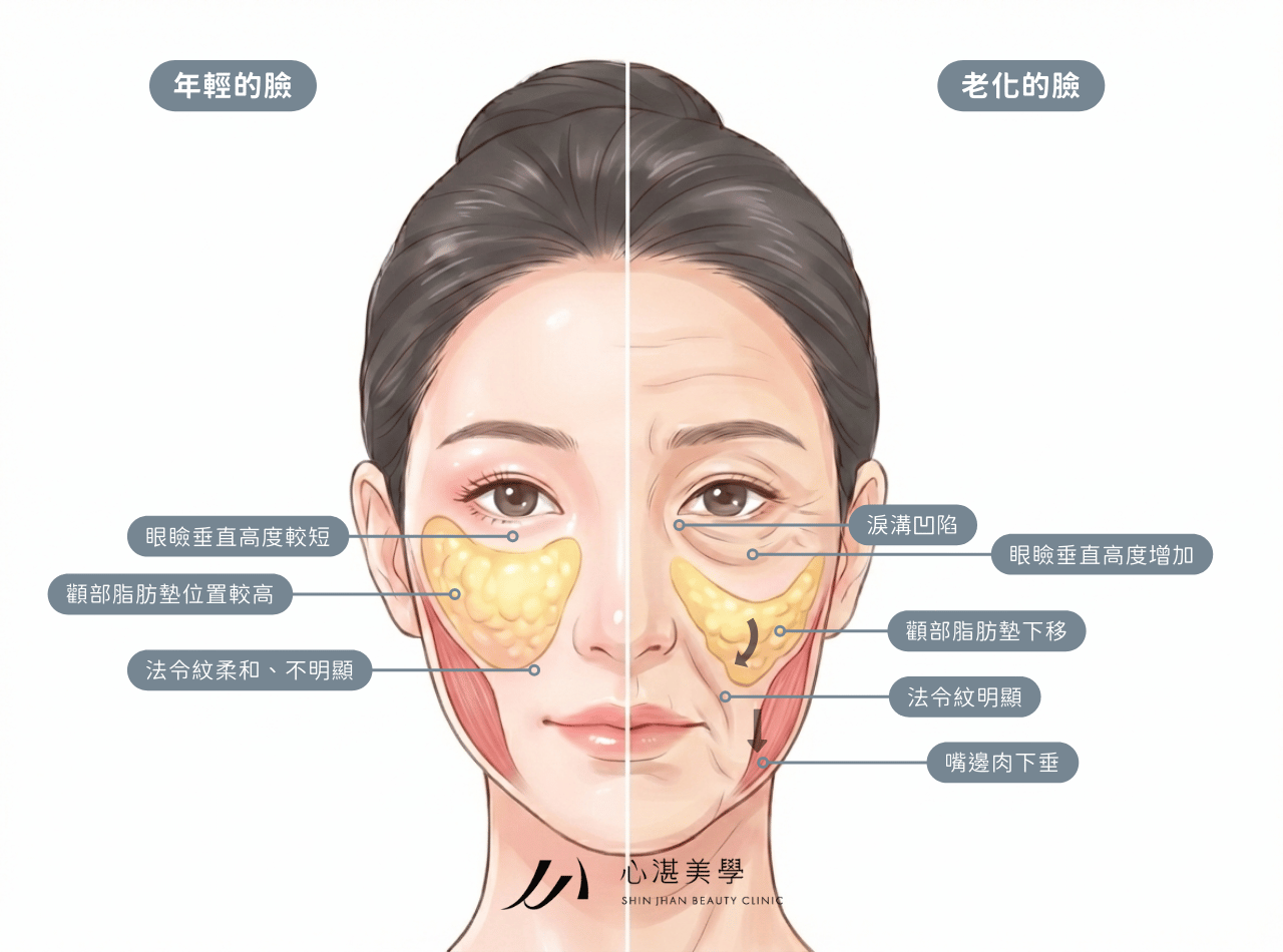 老化的臉與年輕的臉法令紋差異