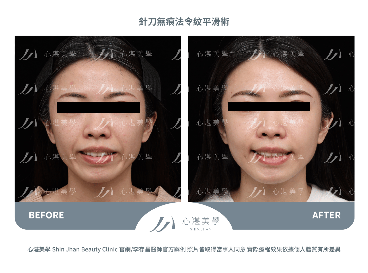 針刀無痕法令紋平滑術案例分享