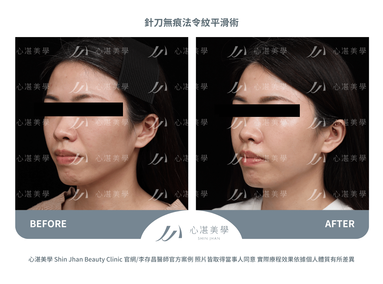 針刀無痕法令紋平滑術案例分享