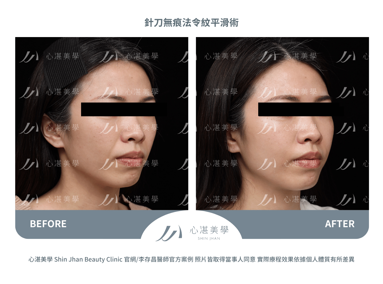 針刀無痕法令紋平滑術案例分享