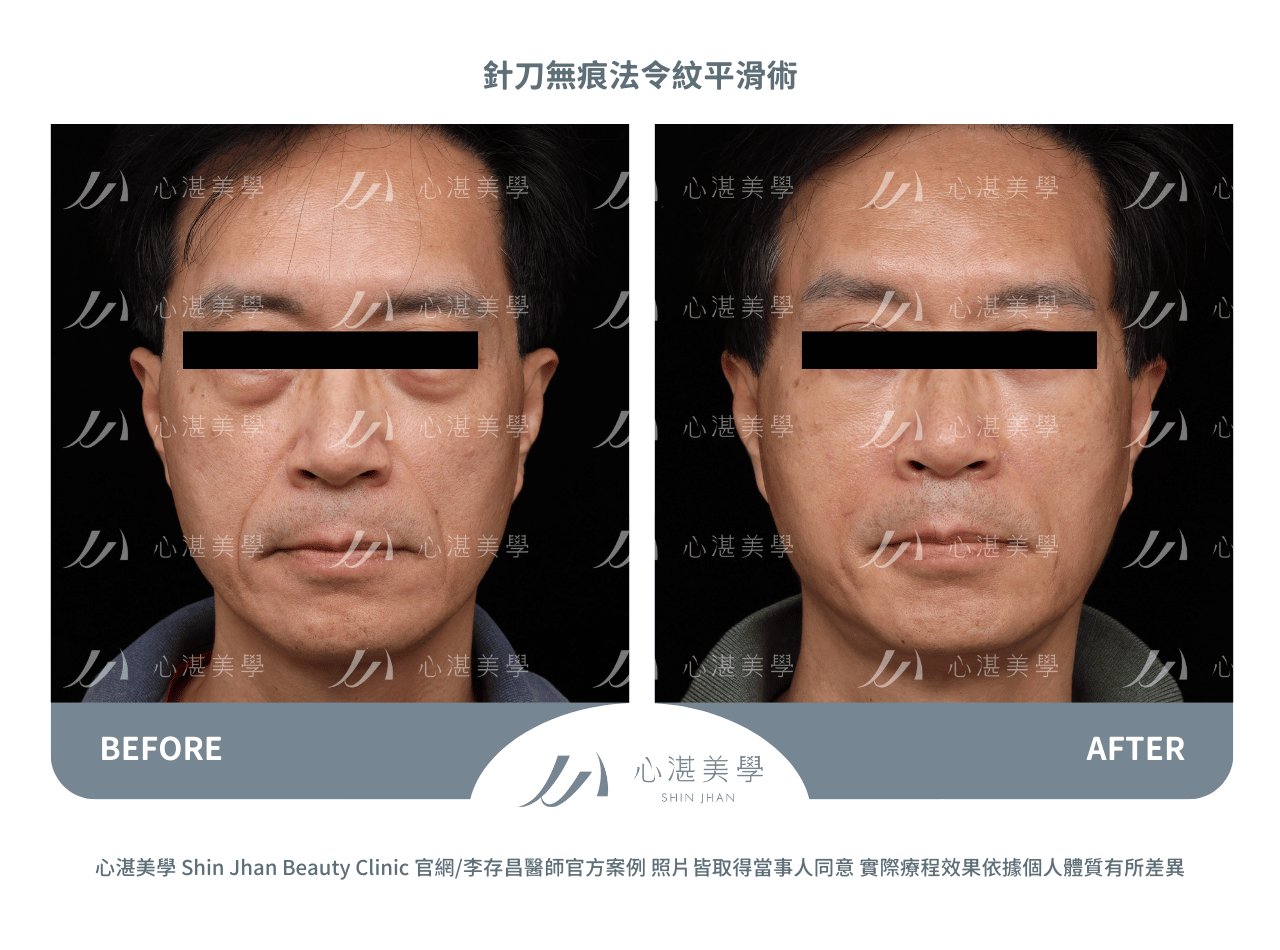 針刀無痕法令紋平滑術案例分享
