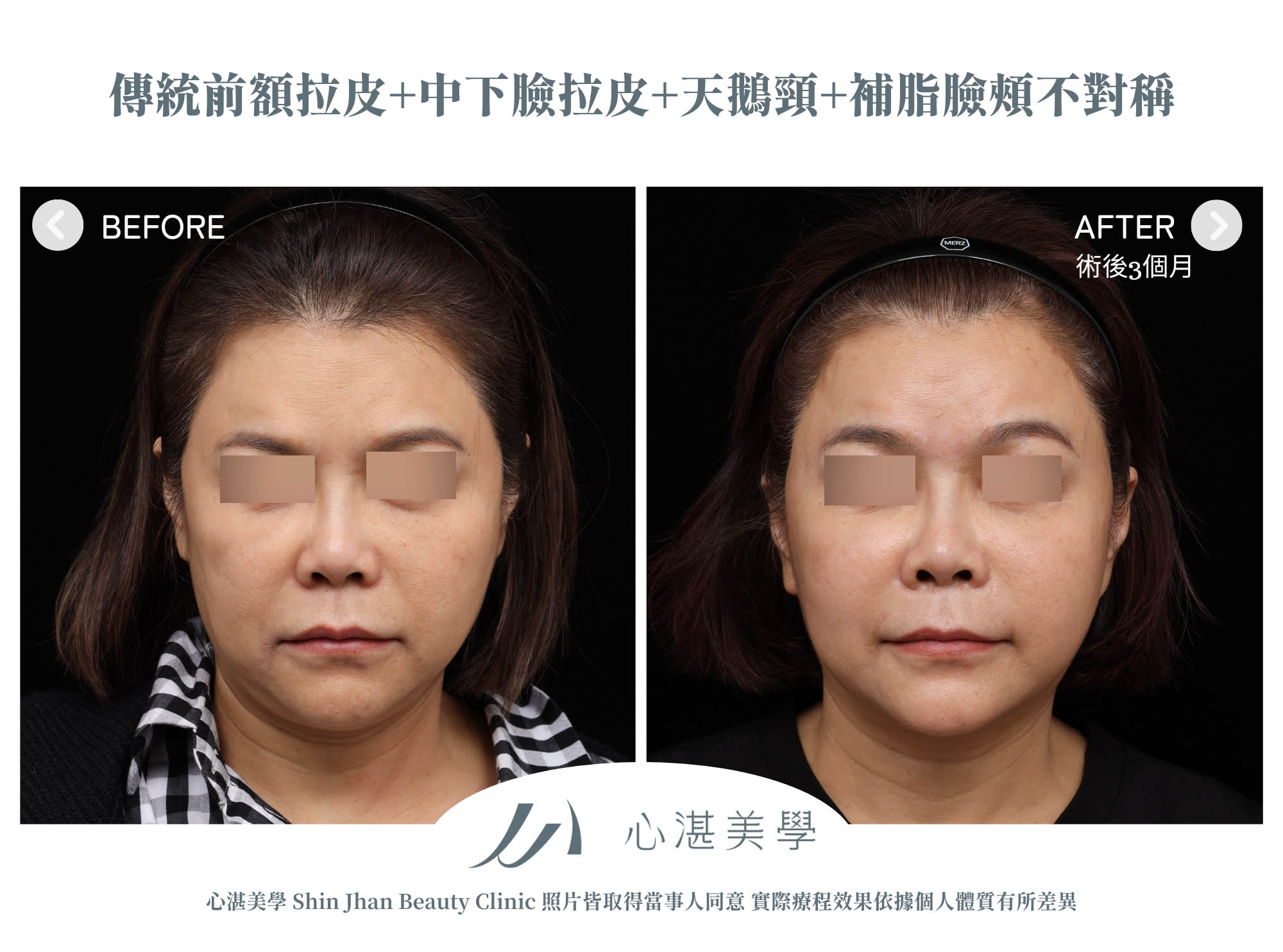 傳統前額拉皮+中下臉拉皮+天鵝頸手術 術前術後分享