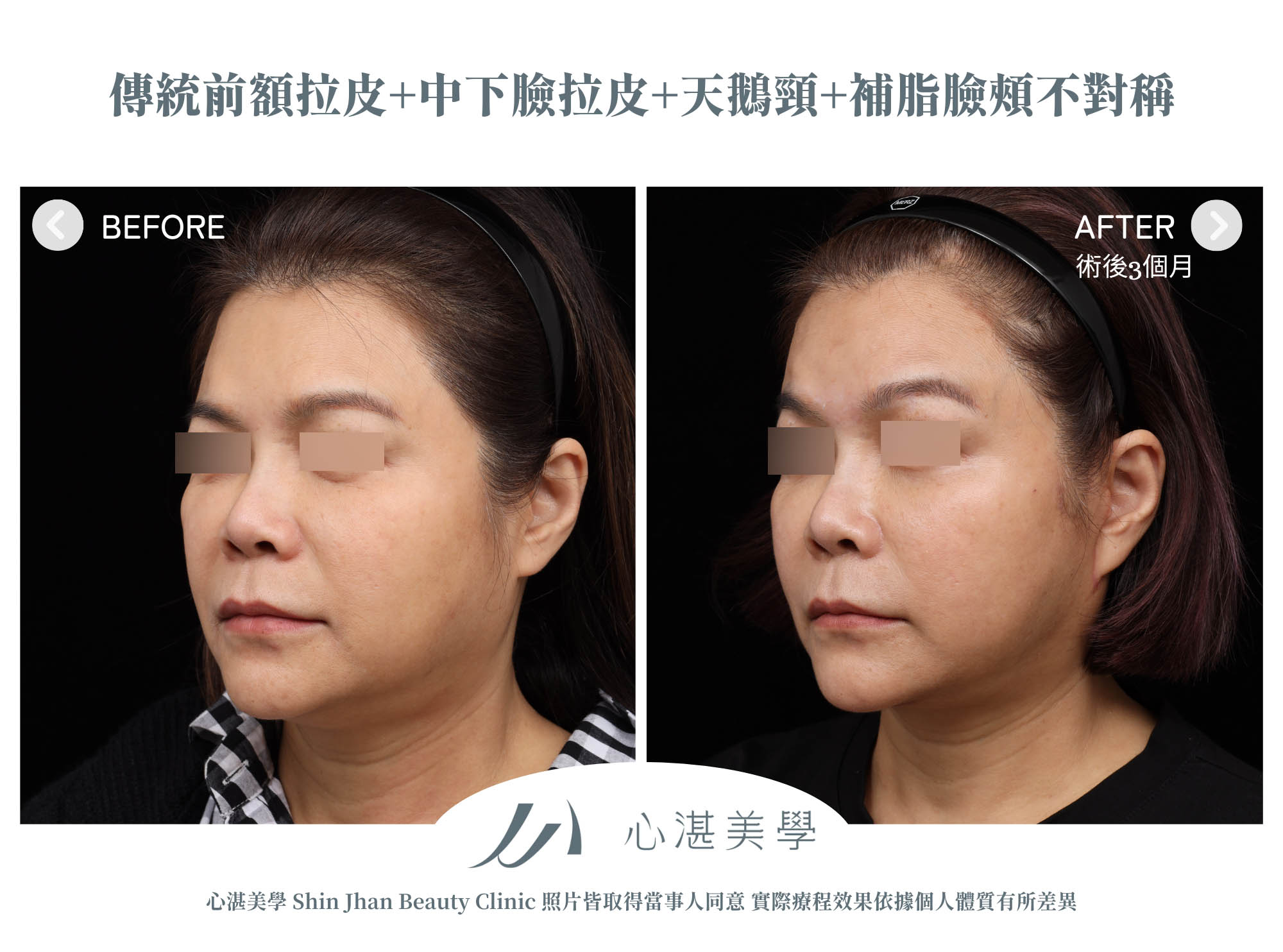 傳統前額拉皮+中下臉拉皮+天鵝頸手術 術前術後分享