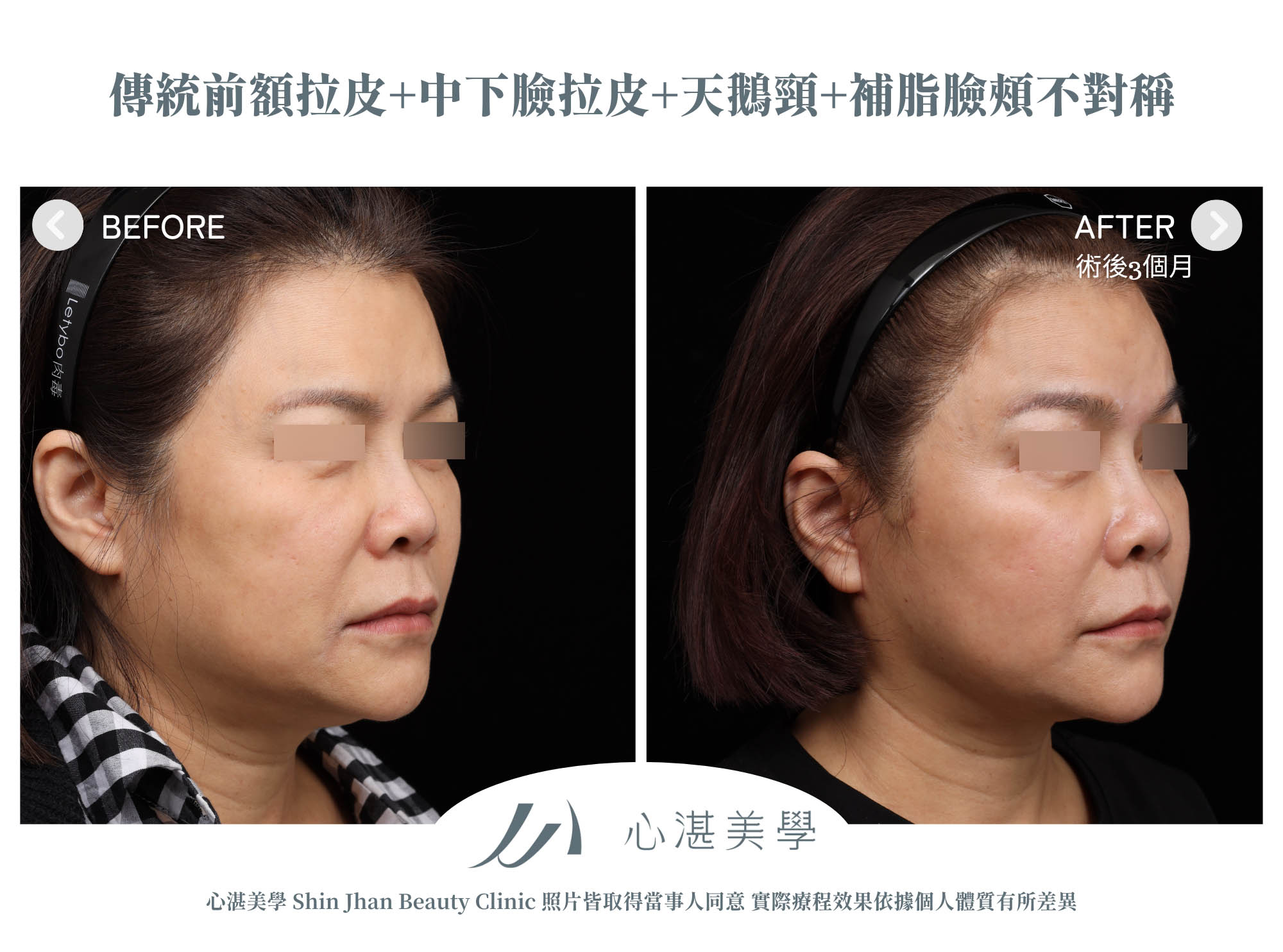 傳統前額拉皮+中下臉拉皮+天鵝頸手術 術前術後分享