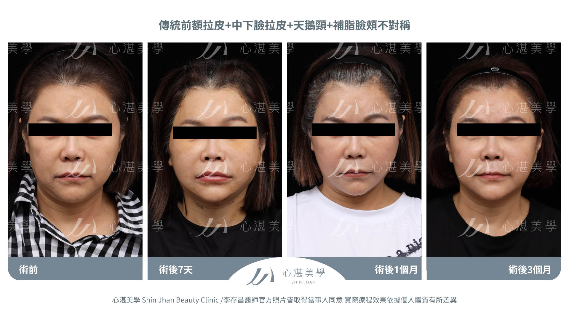 傳統前額拉皮+中下臉拉皮+天鵝頸手術 術前術後分享 術前+術後當下+術後7天+術後1個月