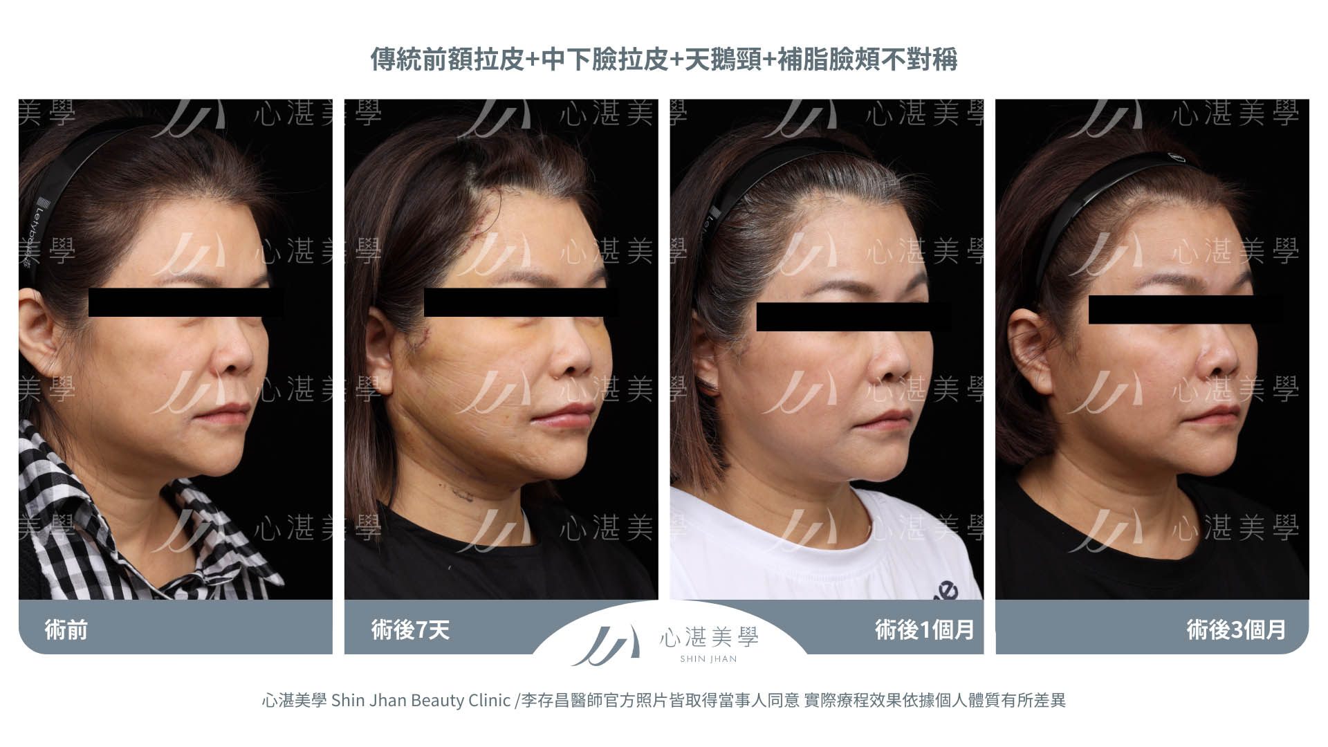 傳統前額拉皮+中下臉拉皮+天鵝頸手術 術前術後分享 術前+術後當下+術後7天+術後1個月