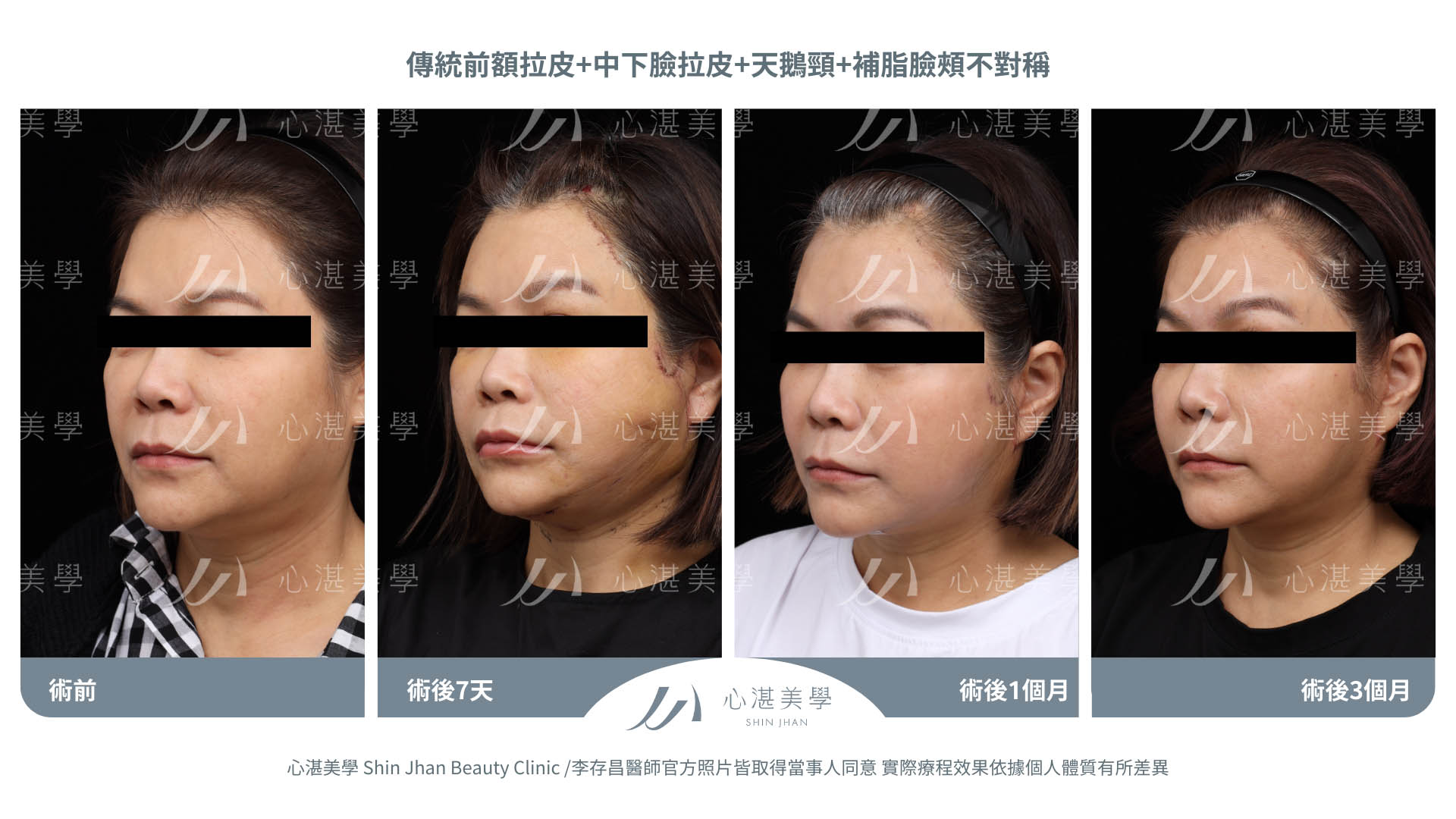傳統前額拉皮+中下臉拉皮+天鵝頸手術 術前術後分享 術前+術後當下+術後7天+術後1個月