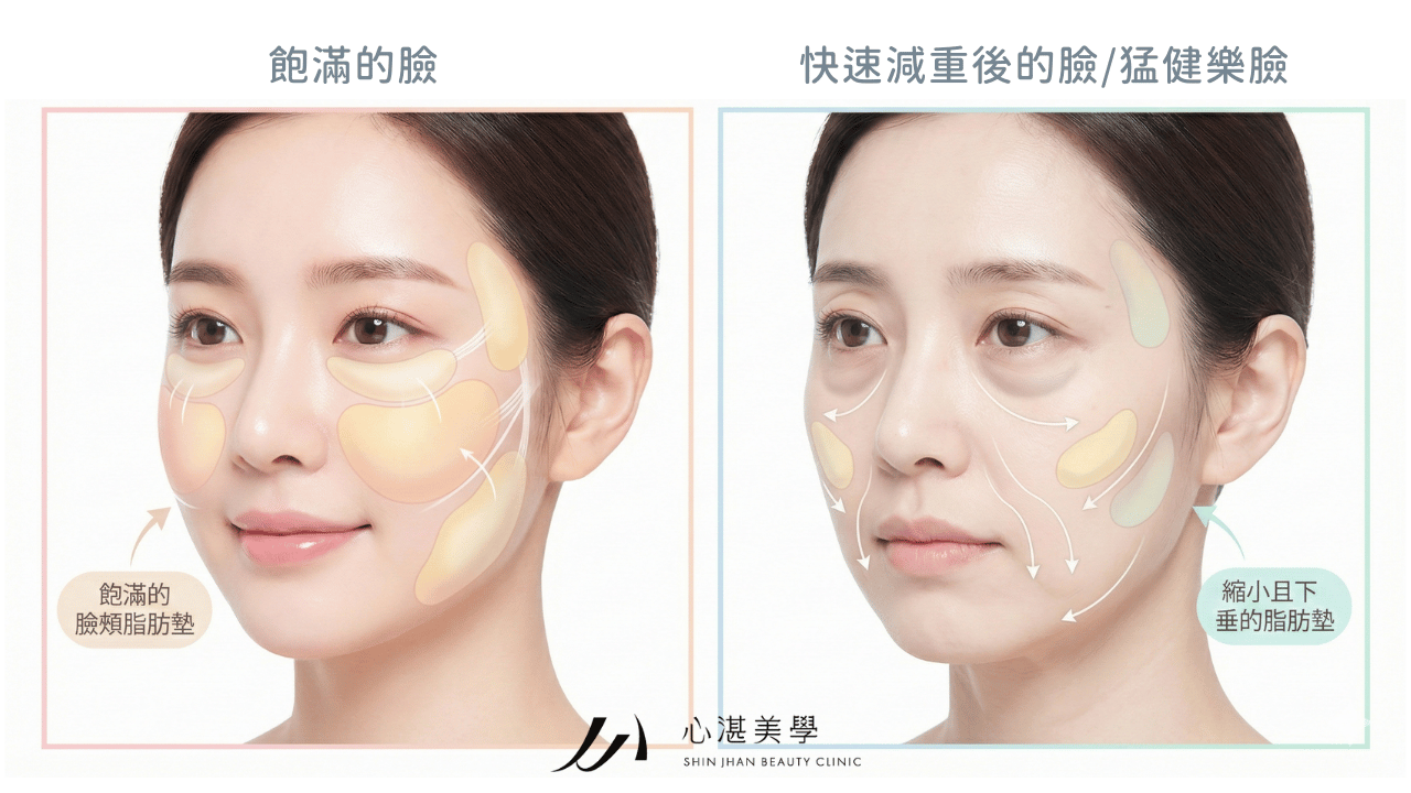 猛健樂臉成因解析，快速減重導致臉部脂肪流失與筋膜層鬆弛示意圖。 快速減重時，臉部深層脂肪的流失速度往往快於皮膚回縮的速度。