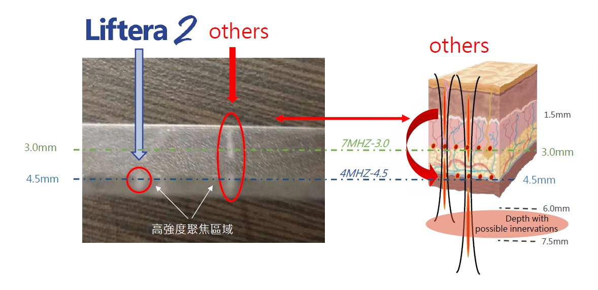 皇后音波Liftera2的做法，是把能量直接送到皮膚深層的問題所在——不是只作用在表皮，而是真的到達SMAS筋膜層、支撐韌帶那個深度。