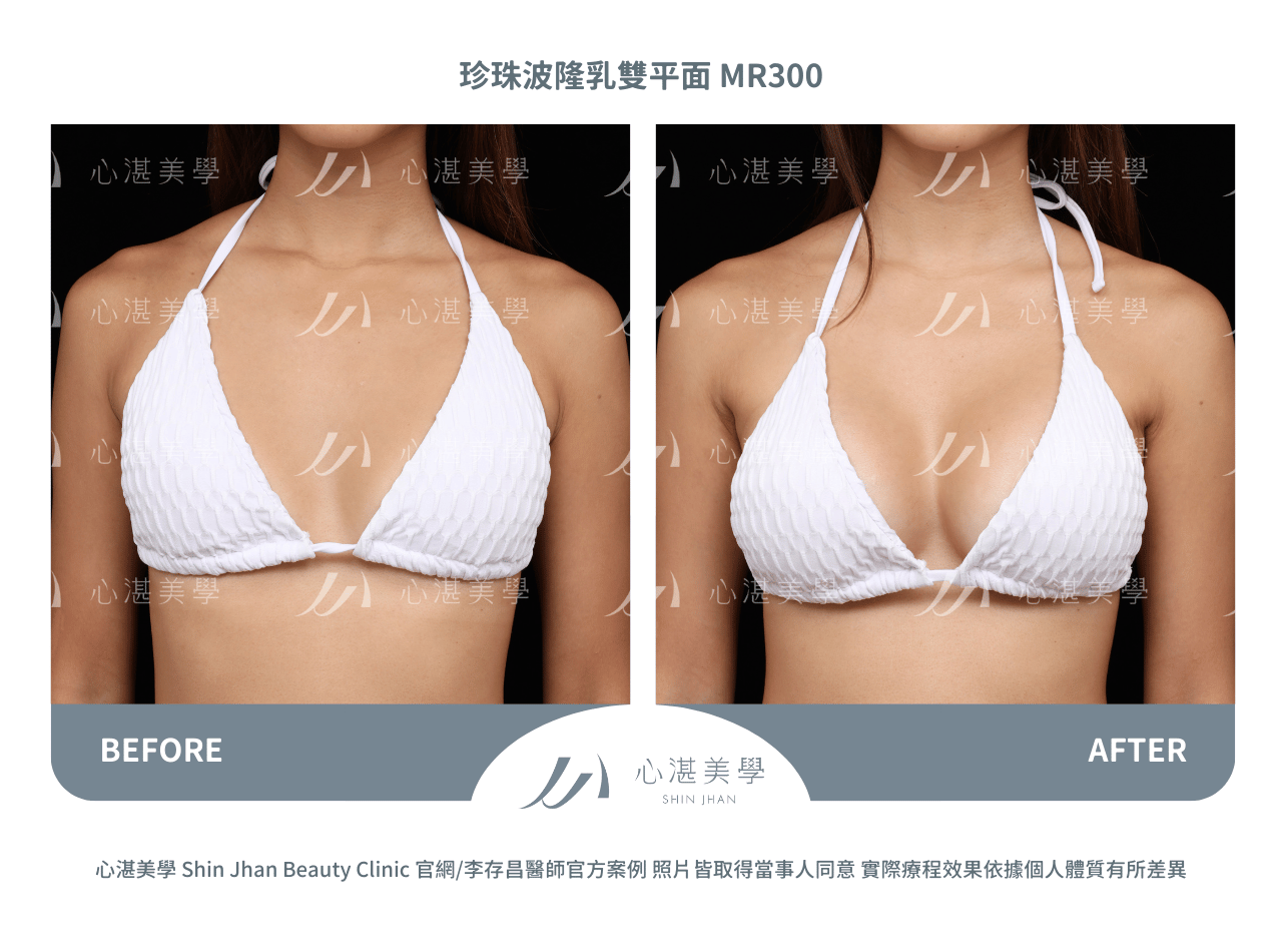 珍珠波隆乳術前術後案例分享