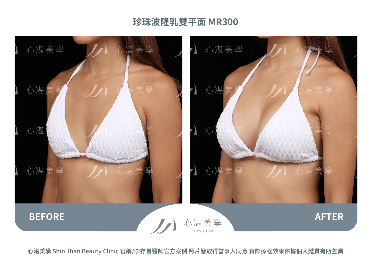 珍珠波隆乳術前術後案例分享