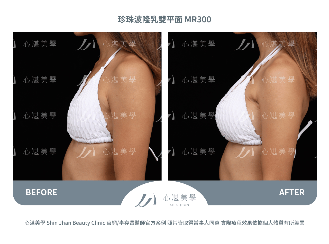 珍珠波隆乳術前術後案例分享