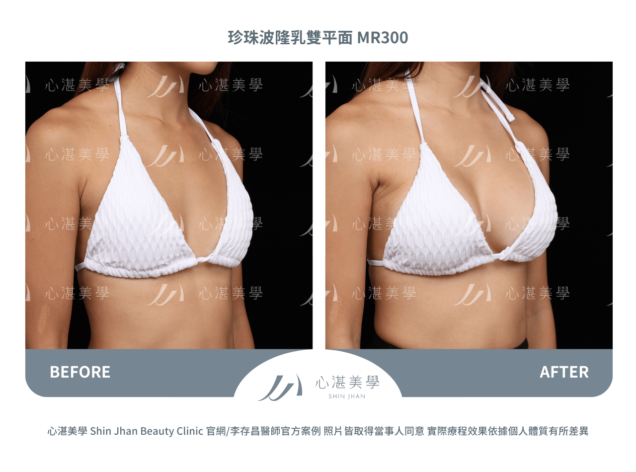 珍珠波隆乳術前術後案例分享
