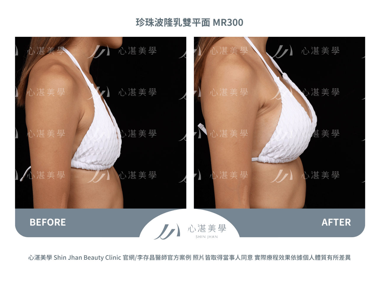 珍珠波隆乳術前術後案例分享