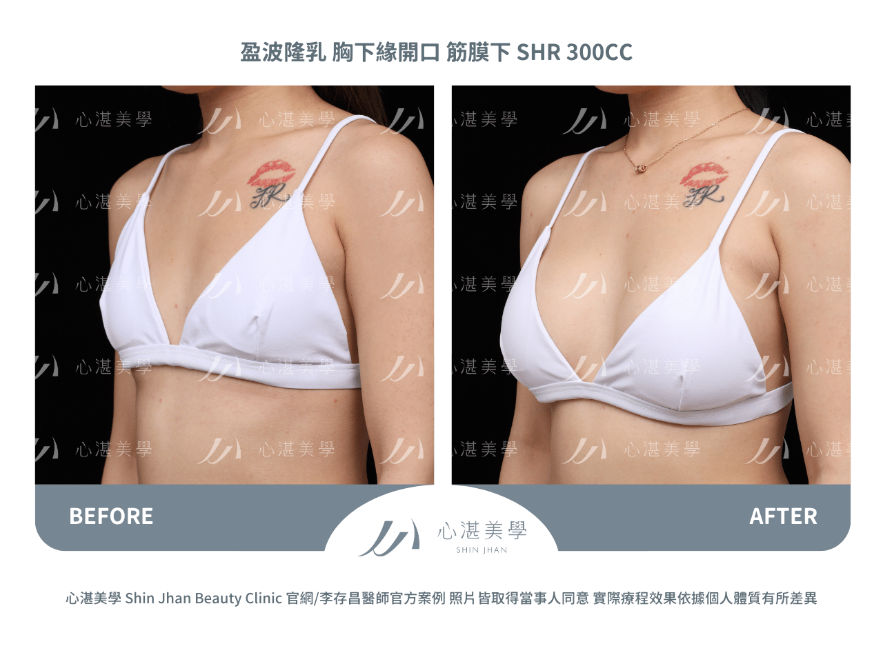 impleo-smooth-before+after (2)