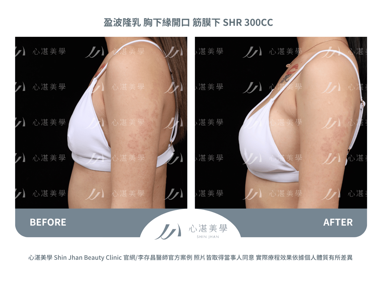 impleo-smooth-before+after (3)