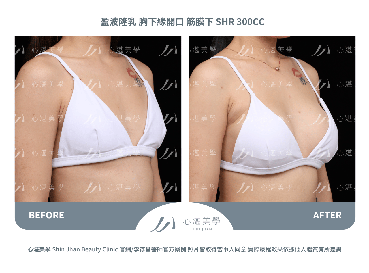 impleo-smooth-before+after (4)
