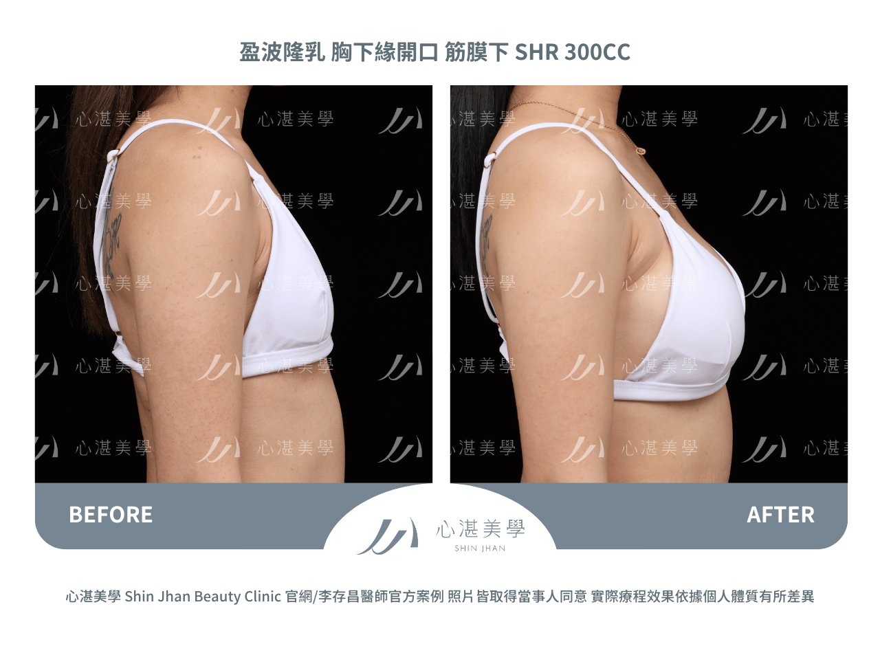 impleo-smooth-before+after (5)
