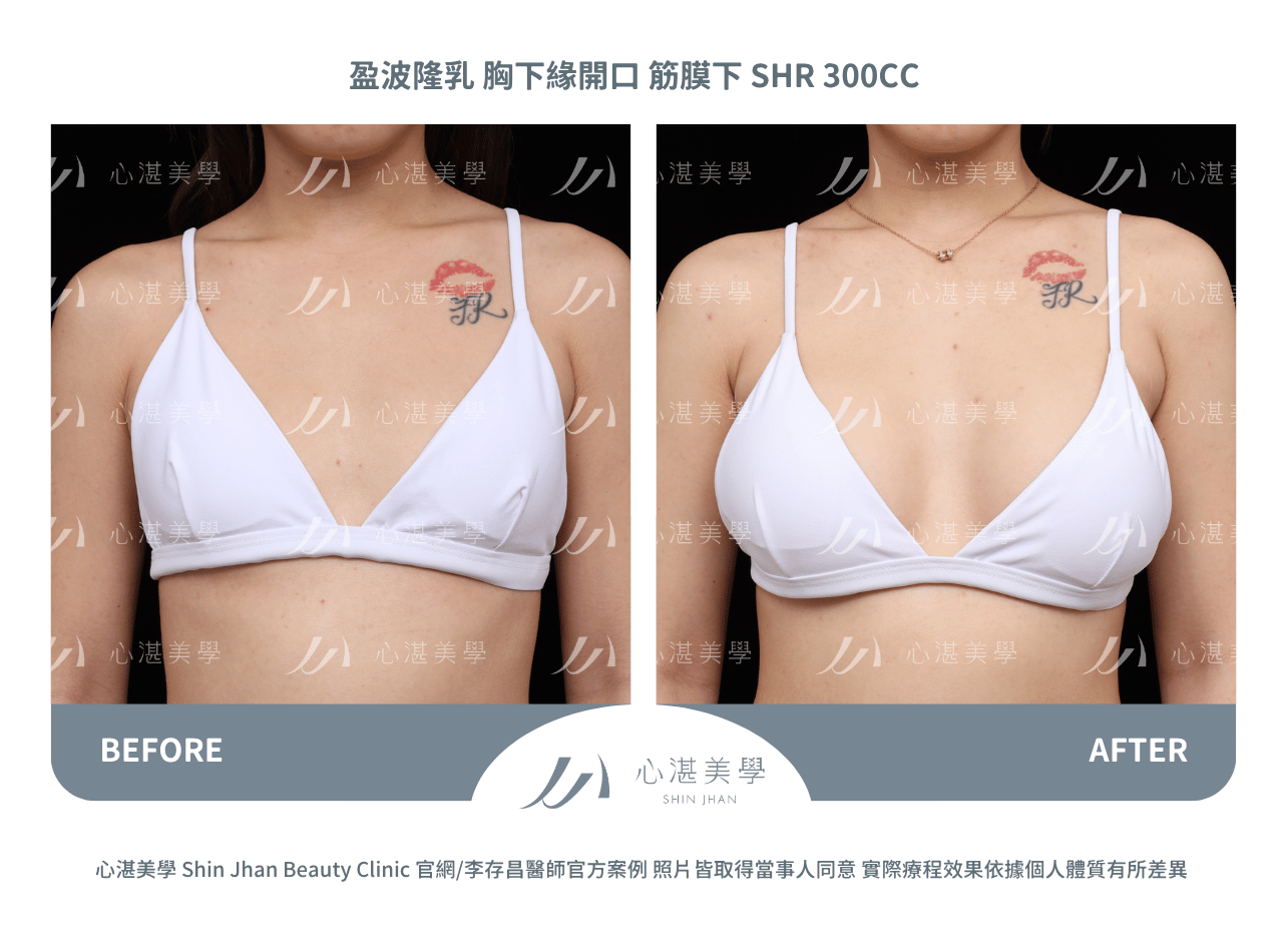 impleo-smooth-before+after