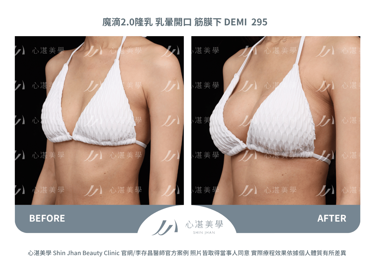 盈波隆乳 胸下緣開口 筋膜下 SHR 300CC 術前術後分享