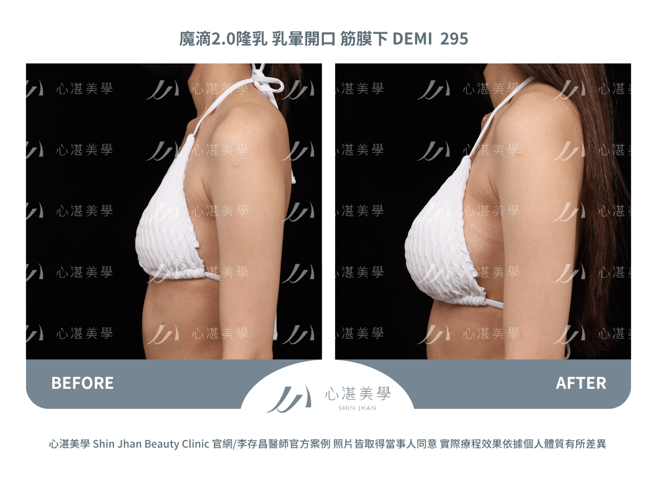 盈波隆乳 胸下緣開口 筋膜下 SHR 300CC 術前術後分享