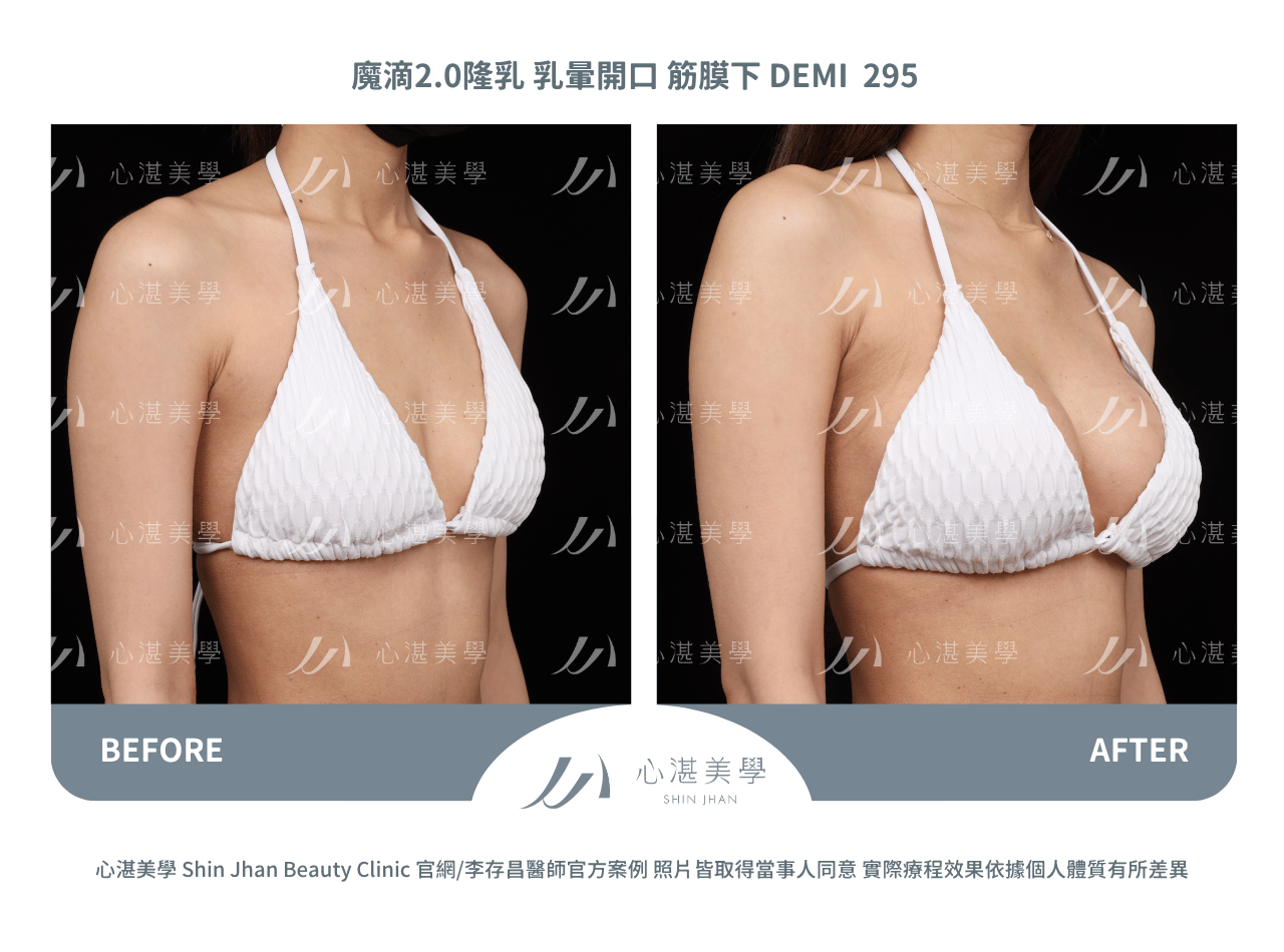 盈波隆乳 胸下緣開口 筋膜下 SHR 300CC 術前術後分享