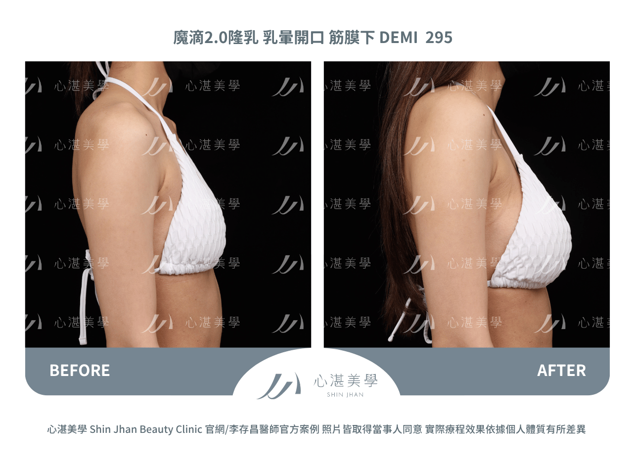盈波隆乳 胸下緣開口 筋膜下 SHR 300CC 術前術後分享